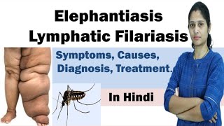 Elephantiasis  Filariasis  Symptoms Causes Diagnosis Treatment Prevention  In Hindi [upl. by Fennessy729]