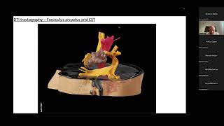 IESSESTM webinar series Global Epilepsy Surgery Technique Rounds [upl. by Westlund]