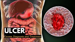 Ulcer Causes Signs and Symptoms Diagnosis and Treatment [upl. by Bethany102]