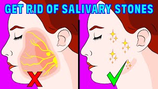 How to Get Rid of Salivary Gland Stones Naturally [upl. by Asirralc788]