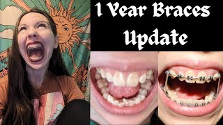 1 YEAR ADULT BRACES UPDATE🦷Progress Elastics Current Routine  More [upl. by Gurtner]