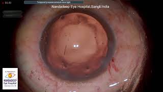 soft cataract 2 cases different techniques Dr Sourabh Patwardhan Live Cataract surgery [upl. by Enymsaj]