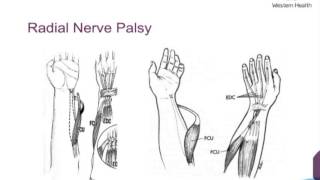 Upper Limb Tendon Transfers by Dr Scott Tulloch [upl. by Bertle404]