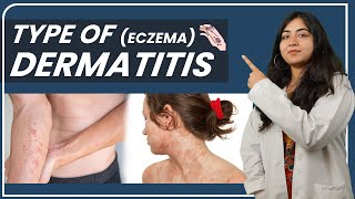 Types of Dermatitis  Eczema  Causes Symptoms And Treatment  Dr Mahima Chaudhary [upl. by Rafaelof850]