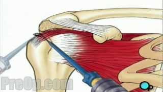 Rotator Cuff Repair Arthroscopic Surgery PreOp Patient Education [upl. by Bruyn]