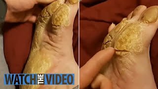 Removing Extremely Hard Foot Callus 🦶 The right way to remove foot callus FULL TREATMENT 06 [upl. by Skvorak]