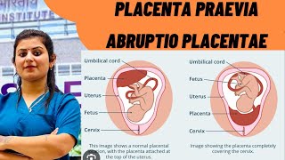 ABRUPTIO  PLACENTA PRAEVIA COMPARISON WITH MCQ EXPLANATIONNCLEX nclexrn internationalstudents [upl. by Jollenta523]