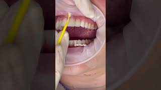 Porcelain veneers before and after  porcelain veneers procedure  Dr Yazdan  dental veneers [upl. by Kcirdnek]