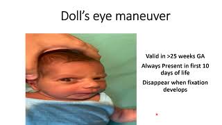 Dolls Eye Maneuver  Pediatrics [upl. by Euqinobe]