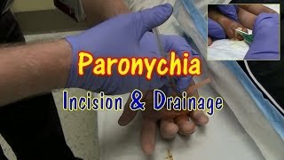 Paronychia Incision and Drainage [upl. by Alios929]