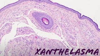 Xanthelasma xanthoma of eyelid yellow bumps around eye pathology dermpath dermatology [upl. by Nnaear]