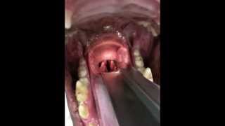 Laryngeal paralysis oral exam [upl. by Brotherson]