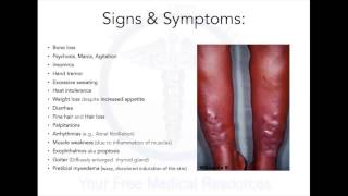 All about Sias Disease  All about this mistery Graves Disease explained [upl. by Nnil]