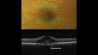 Cystoid Macular Edema in Pars Planitis OCT Interpretation [upl. by Asselem]