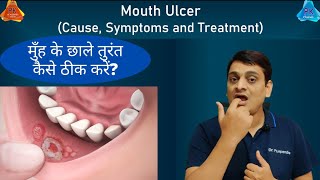 Mouth Ulcer  Treatment for Immediate Relief By Dr Puspendra [upl. by Clovis]