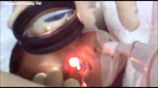 Laser Treatment of Retinopathy of prematurity ROP [upl. by Aronek]