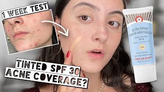 TESTING FIRST AID BEAUTY ULTRA REPAIR TINTED MOISTURIZER SPF 30 On ACNE for 1 Week  Acne Coverage [upl. by Newcomer822]