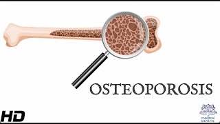 Osteoporosis Everything You Need To Know [upl. by Acireed]