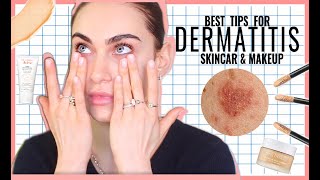 How I Treat My Dermatitis  Makeup for Dermatitis  Eczema  Ruby Golani [upl. by Ueik]