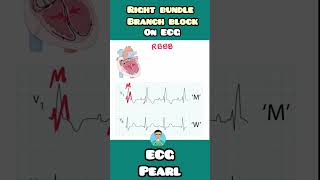 RBBB Right Bundle Branch Block on ECG  quick mnemonic for USMLE NEET PG INICET NCLEX mednotes [upl. by Nico]