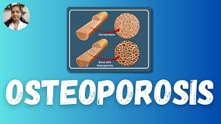 Osteoporosis  Bimithas Nursing Guide osteoporosis psckerala [upl. by Amliv]