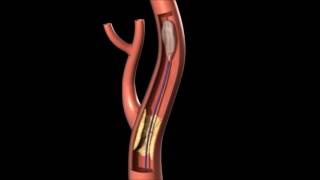 CarotisAngioplastie mit Stent und Protektionssystem [upl. by Rupert]