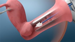 Pap and HPV Testing [upl. by Geer]