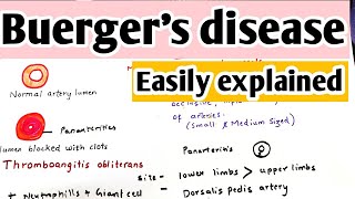 Buergers disease  Thromboangitis obliterans  Definition causes pathophysiology treatment [upl. by Ailis]