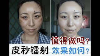 PicoSure Laser Review  BeforeampAfter皮秒镭射体验＋前后对比MsLindaY [upl. by Yarahs958]