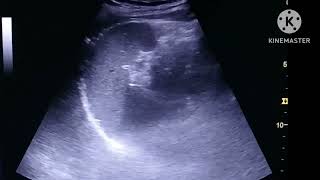 Ureteric stone on Ultrasound [upl. by Assened]