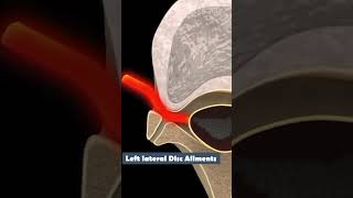 Left Lateral Disc Ailments [upl. by Oberheim]