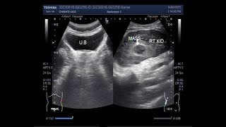 A Renal Mass [upl. by Emily127]