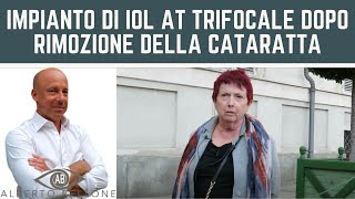 Impianto di IOL AT Trifocale dopo rimozione della cataratta [upl. by Ecnaled]