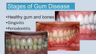 Stages of gum disease final edit 3 [upl. by Anikas569]