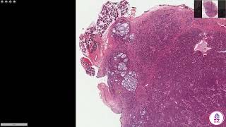 Adenoid Cystic Carcinoma [upl. by Barlow384]