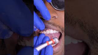 How Tooth Shaving Works [upl. by Nilesoy]