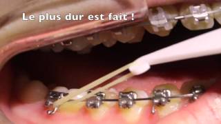 Mettre ses élastiques intermaxillaires en orthodontie [upl. by Lupe466]