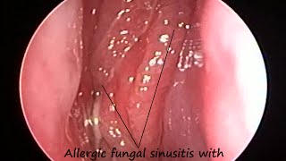 Nose Endoscopy  Allergic Fungal Sinusitis with SinuNasal Polyposis amp Post Nasal Discharge PND [upl. by Thia967]