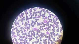 Leucémie  Promyélocytes Myélocytes Métamyélocytes Promonocytes et les blastes  سرطان الدم [upl. by Eiznekcm484]