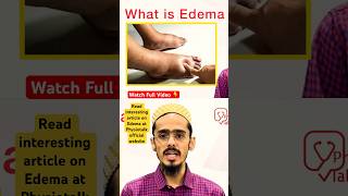 Edema क्या होता है  इसके Types क्या होते है  edema swelling shortsfeed [upl. by Lovel]