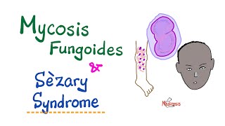 Mycosis Fungoides and Sèzary Syndrome [upl. by Tanaka822]