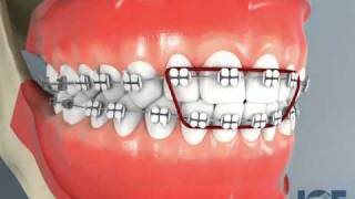 Ortodoncia Monterrey Arreglo de Mordida abierta consultoriobmd wwwdentistamonterreymx [upl. by Northway]