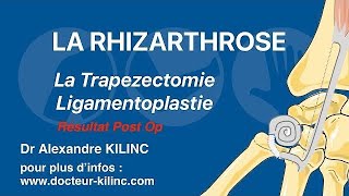 Trapezectomie pour traiter une rhizarthrose ou arthrose du pouce  résultat [upl. by Enylorac]