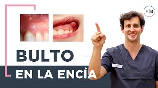 👉 ¿Sabes cómo se quita un BULTO en la ENCÍA 👄 TIPOS de bulto y CÓMO ELIMINARLOS [upl. by Labaw]