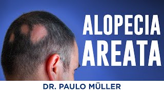 Alopecia Areata Falhas no Cabelo  Dr Paulo Müller Dermatologista [upl. by Winston]