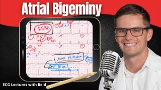 Atrial Bigeminy EKG  ECG Lecture [upl. by Imis]