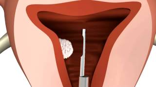 MyoSure Procedure Animation [upl. by Juli350]