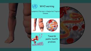 Elephantiasis science elephantiasishealthylifestyle [upl. by Tammi446]