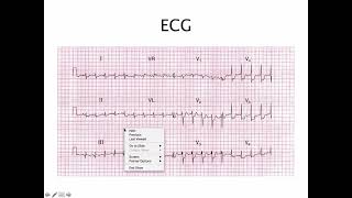 59 EKG case anterior ischemia  ករណីសិក្សារECGលើអ្នកជំងឺមានត្បៀតសសៃឈាមបេះដូង [upl. by Gordy32]