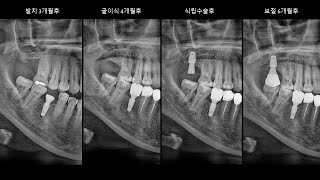 20240526 17 GBR BAOSFE Staged Approach Implant The result of bovine bone graft Kisplant [upl. by Drus]